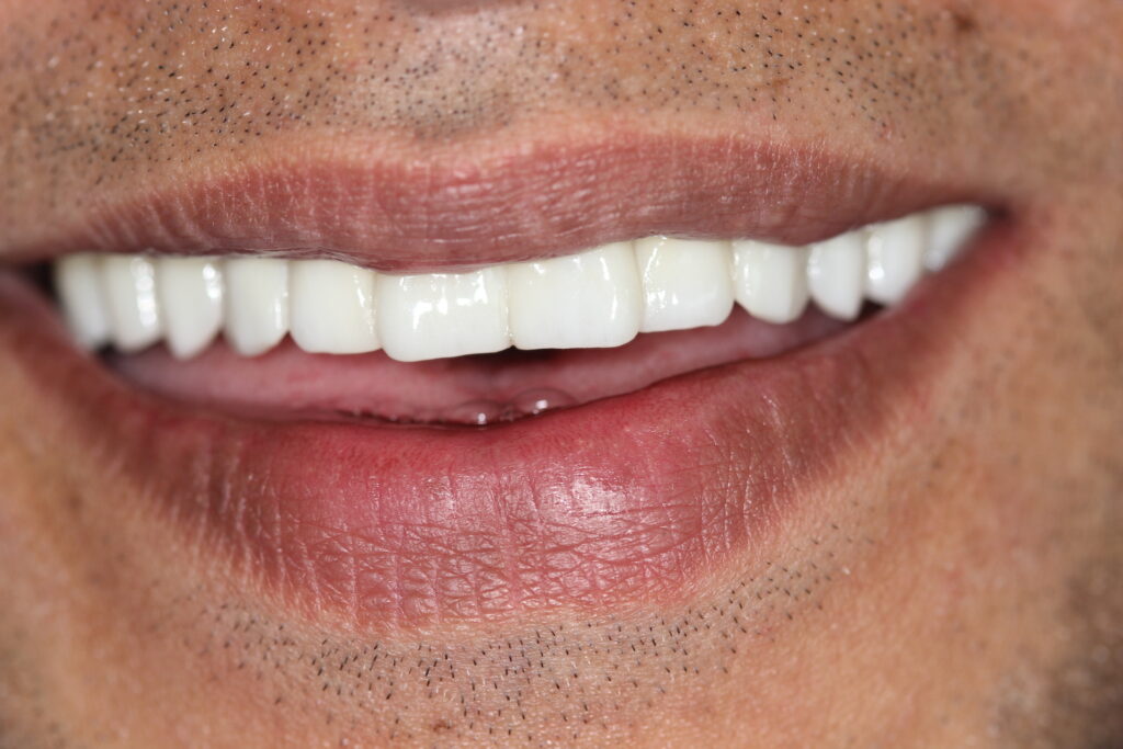 After treatment photo showing a newly fitted ceramic dental bridge by Princeton Prosthodontics, enhancing patient's smile.