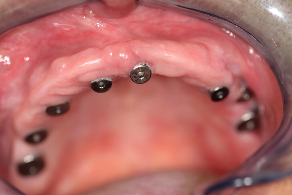 Initial condition of upper jaw before receiving dental implants at Princeton Prosthodontics, showcasing the area of treatment.