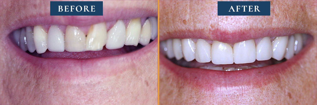 Before and after gallery photo showing dramatic smile enhancement with dental treatments from Princeton Prosthodontics.