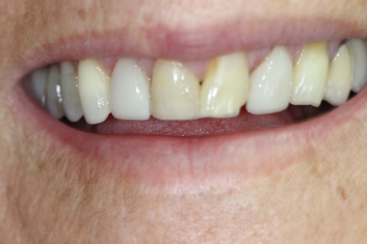 Before photo displaying dental issues prior to treatment at Princeton Prosthodontics.
