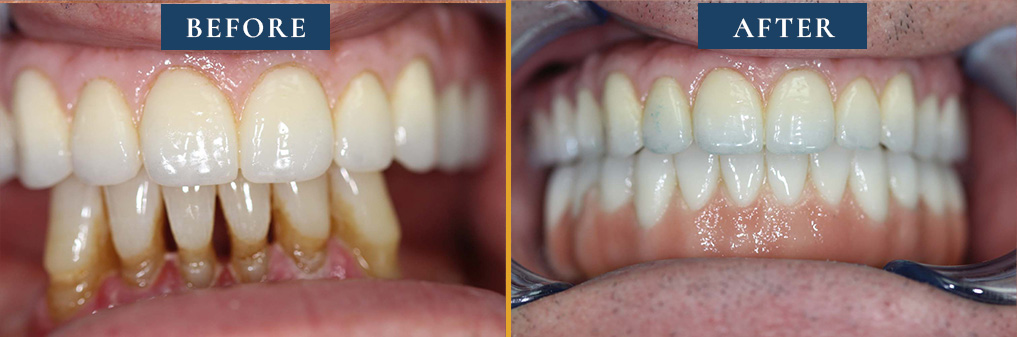 Comparative smile gallery image illustrating the effectiveness of Princeton Prosthodontics' cosmetic dental procedures.