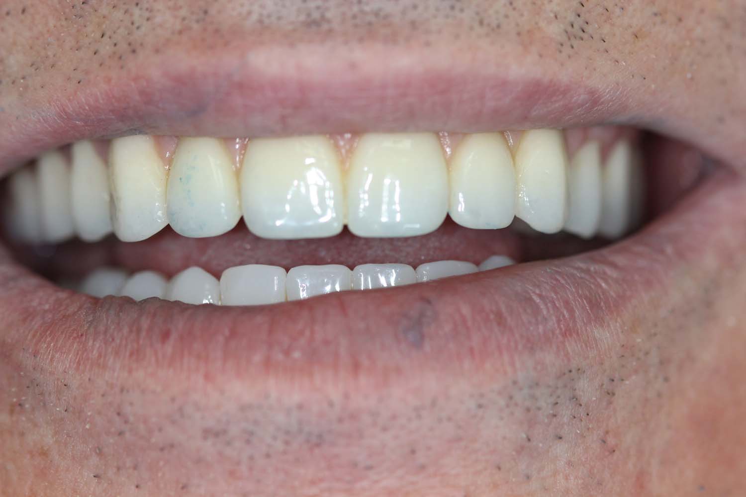 Post-treatment photo highlighting the remarkable results of cosmetic dentistry at Princeton Prosthodontics.