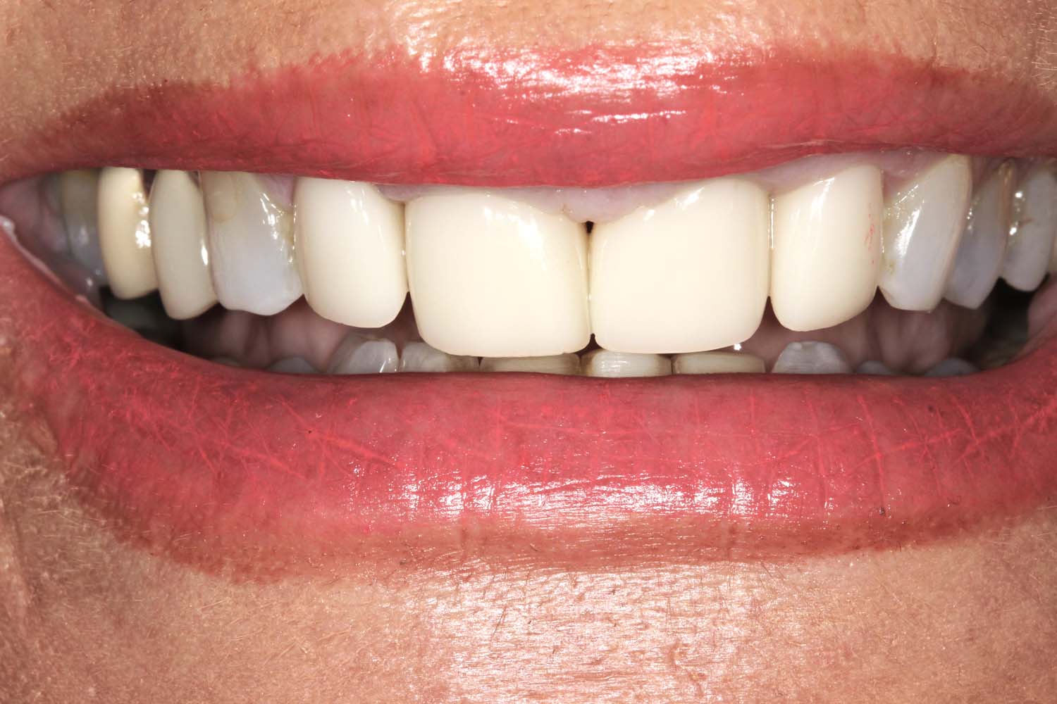 Impressive after photo demonstrating the expertise in dental aesthetics at Princeton Prosthodontics.