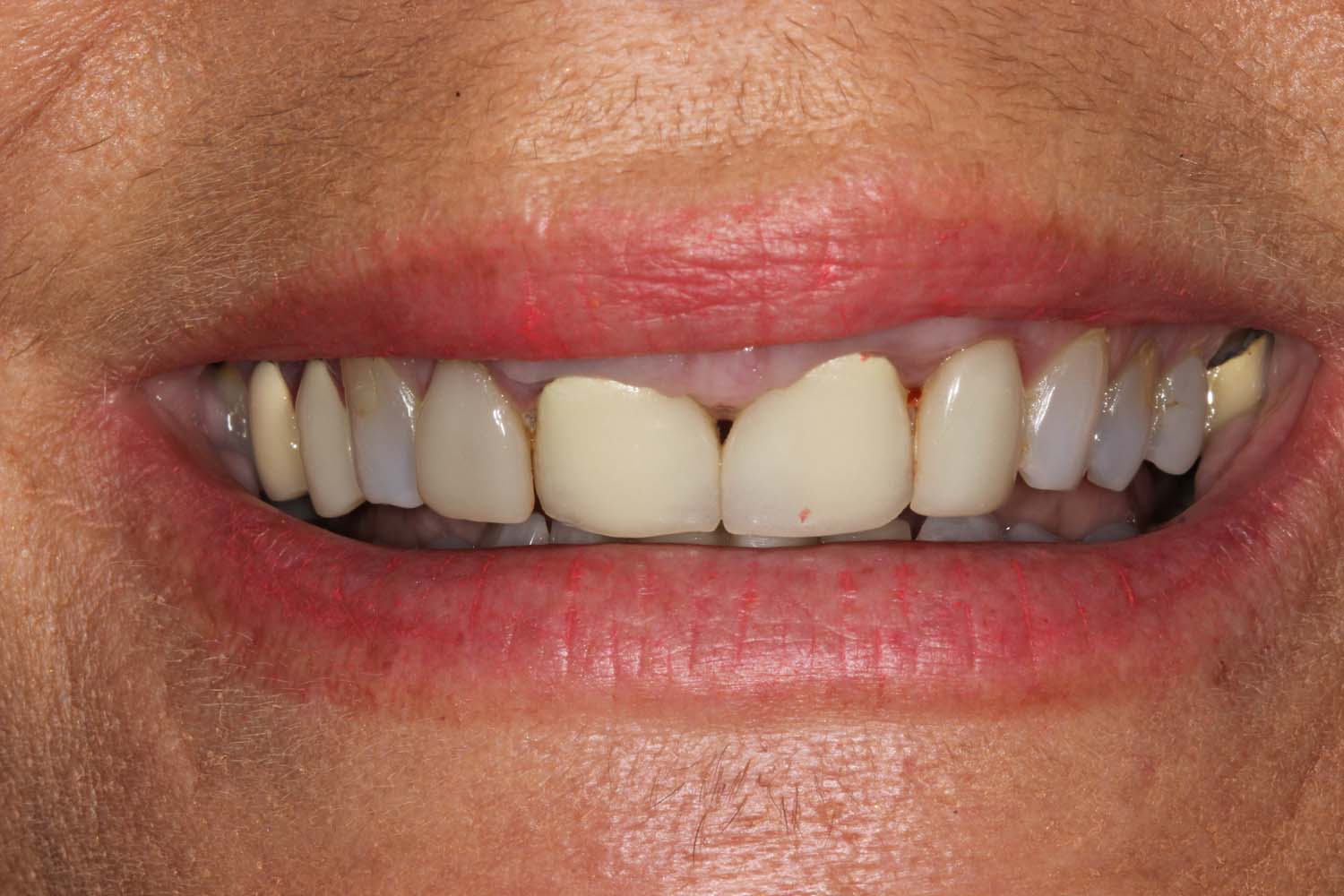 Before photo showing dental imperfections, soon to be treated by Princeton Prosthodontics.