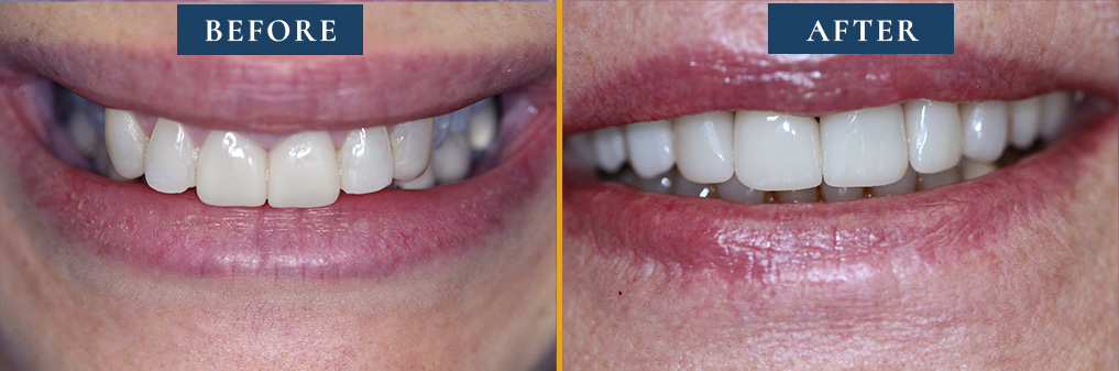 Smile evolution depicted in a before and after photo at Princeton Prosthodontics, demonstrating advanced dental restoration techniques.