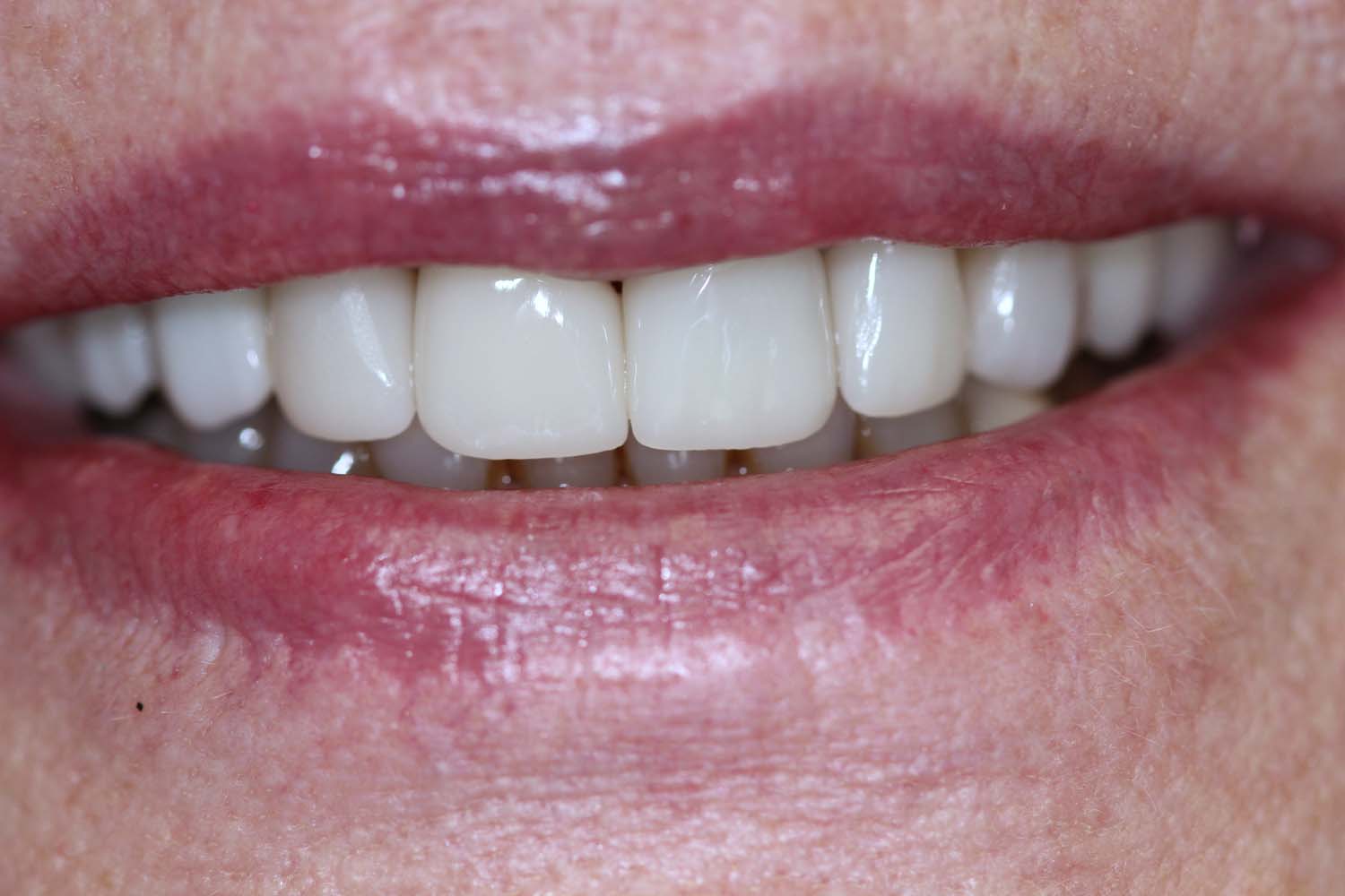 Exemplary after photo showcasing a bright, healthy smile, courtesy of Princeton Prosthodontics.