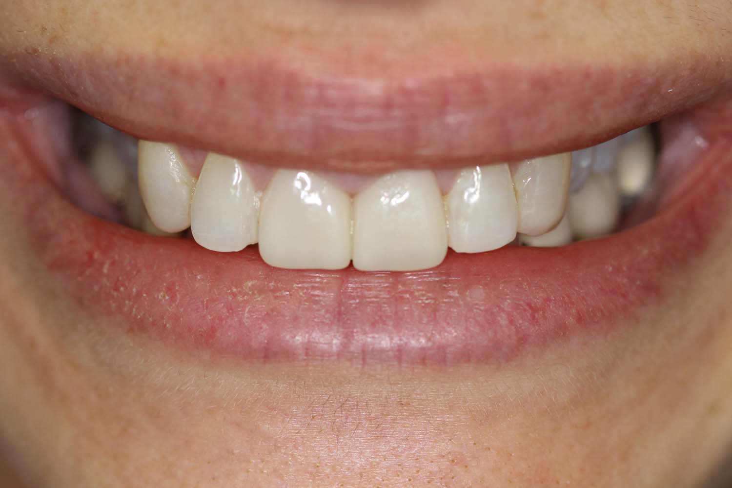 Initial dental condition in a before photo at Princeton Prosthodontics.