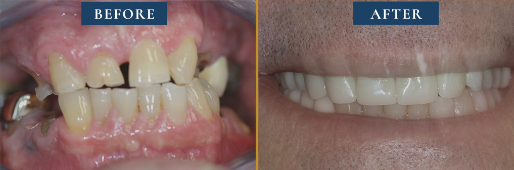 Visual testimony in Princeton Prosthodontics' smile gallery, displaying a patient's oral makeover before and after treatment.
