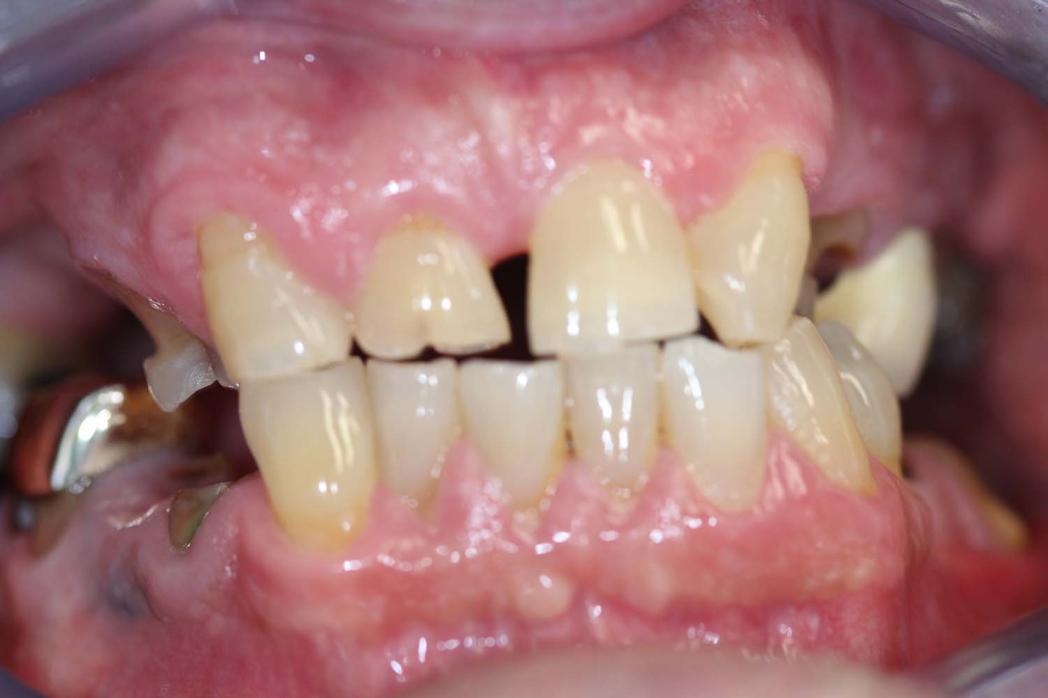 Further illustration of dental transformation, before treatment at Princeton Prosthodontics.