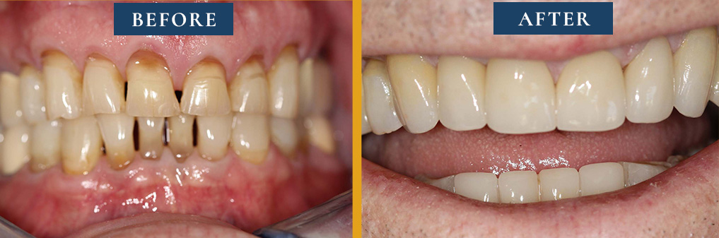 Gallery showcase of a patient's smile reconstruction, before and after expert treatment at Princeton Prosthodontics.