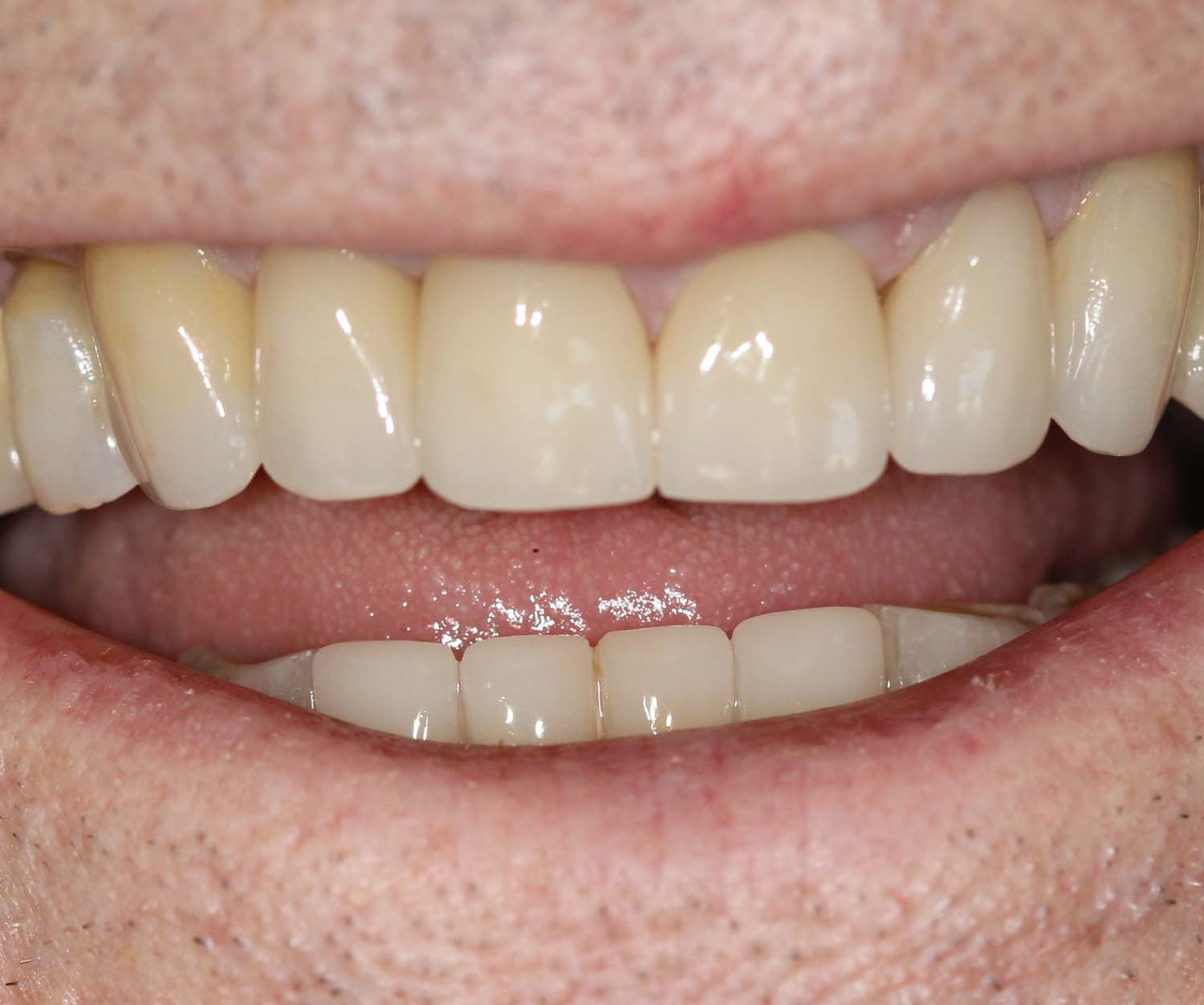 Radiant smile in an after photo, achieved by the skilled team at Princeton Prosthodontics.