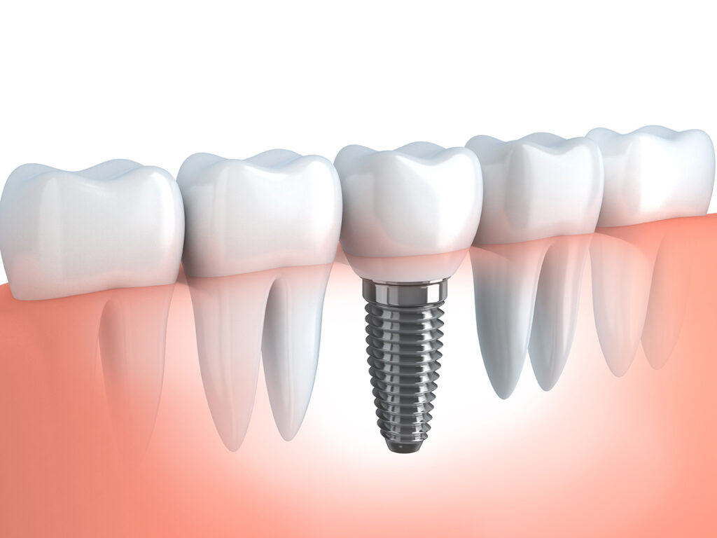 Anatomical illustration showing a molar dental implant, representing the high-quality implant options at Princeton Prosthodontics.